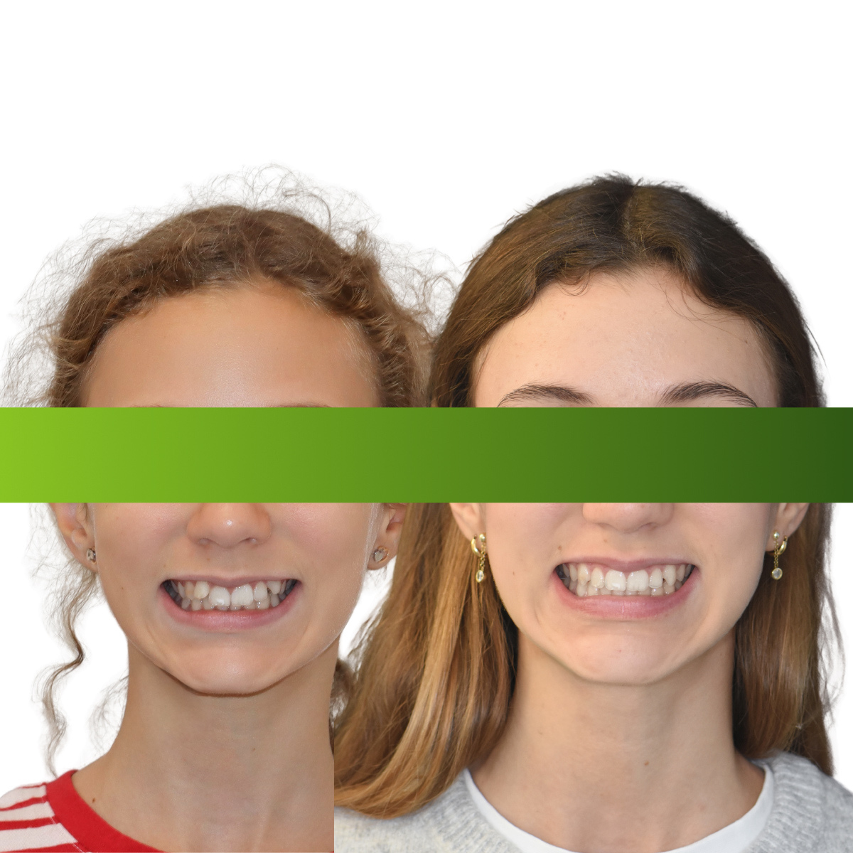 Prima e dopo ortodonzia con allineatori trasparenti: II classe sottodivisione con distalizzazione sequenziale — Studio Di Vito, Monte Porzio Catone